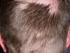 alopecia-droga2__protectwyjqcm90zwn0il0_focusfillwzi5ncwymjisinkildg1xq-4201284-5829105