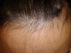 alopecia-droga3__protectwyjqcm90zwn0il0_focusfillwzi5ncwymjisingildbd-2572449-5223045