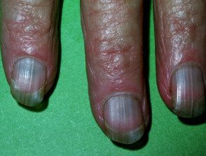 La minociclina indujo la pigmentación de las uñas
