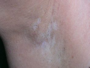 vitiligo induzido por drogas-2__protectwyjqcm90zwn0il0_focusfillwzi5ncwymjisingildfd-7566053-4313513