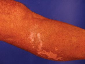 vitiligo induzido por drogas-3__protectwyjqcm90zwn0il0_focusfillwzi5ncwymjisingildbd-4240307-3544619