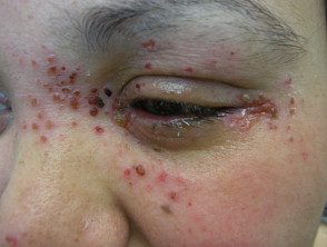 eczema-herpticum08__protectwyjqcm90zwn0il0_focusfillwzi5ncwymjisingildfd-2572683-2054678