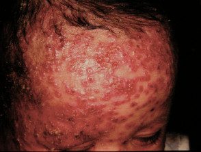 eczema-herpticum18__protectwyjqcm90zwn0il0_focusfillwzi5ncwymjisingildfd-2311071-4346794
