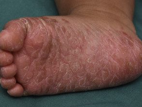 enteroviral-foot-blisters-012__protectwyjqcm90zwn0il0_focusfillwzi5ncwymjisingilde5xq-8726009-3989284