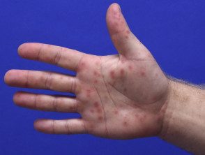Infección enteroviral: ampollas en la mano