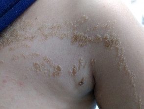 Síndrome de nevus epidérmico