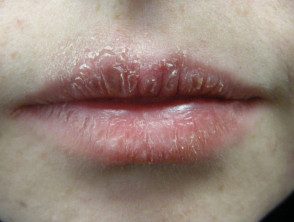 exfoliative-cheilitis1__protectwyjqcm90zwn0il0_focusfillwzi5ncwymjisingildfd-6853410-9128401