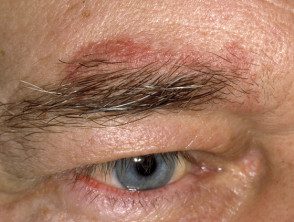 Dermatitis seborreica en las cejas