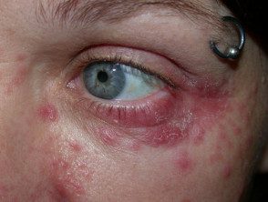 Dermatitis periocular / periorificial