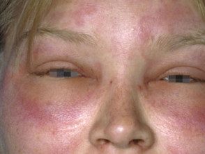 Angioedema