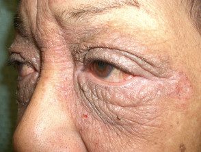 eyelid-dermatitis-02__protectwyjqcm90zwn0il0_focusfillwzi5ncwymjisingildfd-7572166-4579746