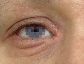 eyelid-dermatitis-07__protectwyjqcm90zwn0il0_focusfillwzi5ncwymjisingildfd-5564112-7155814