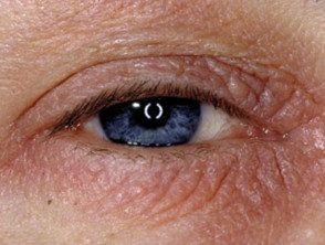 eyelid-dermatitis-08__protectwyjqcm90zwn0il0_focusfillwzi5ncwymjisingildfd-3817018-3736456