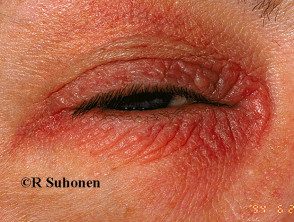 eyelid-dermatitis-10__protectwyjqcm90zwn0il0_focusfillwzi5ncwymjisinkildjd-5706909-1960957
