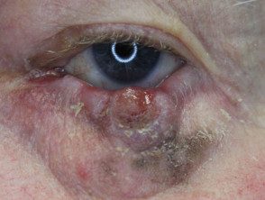 eyelid-melanoma-3__protectwyjqcm90zwn0il0_focusfillwzi5ncwymjisingildfd-6882099-9414467