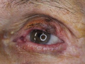 eyelid-melanoma-4__protectwyjqcm90zwn0il0_focusfillwzi5ncwymjisingildfd-8723078-7578006