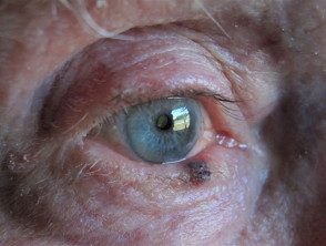 eyelid-melanoma-5__protectwyjqcm90zwn0il0_focusfillwzi5ncwymjisingildzd-9835094-1808335