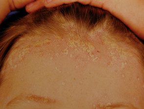 psoriasis facial03__protectwyjqcm90zwn0il0_focusfillwzi5ncwymjisingildfd-2616721-1397761