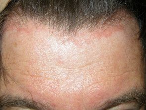 psoriasis facial05__protectwyjqcm90zwn0il0_focusfillwzi5ncwymjisingildfd-3469547-1353956