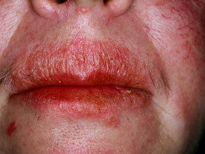 facial-psoriasis17__protectwyjqcm90zwn0il0_focusfillwzi5ncwymjisingildizxq-8972466-5287330