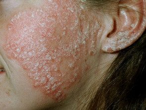 facial-psoriasis21__protectwyjqcm90zwn0il0_focusfillwzi5ncwymjisingildfd-5716282-2430458