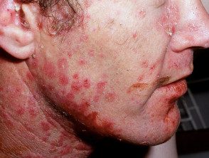 facial-psoriasis22__protectwyjqcm90zwn0il0_focusfillwzi5ncwymjisingildfd-4389602-1942302