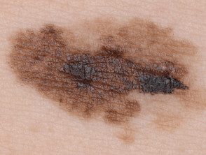 Melanoma de diseminación superficial