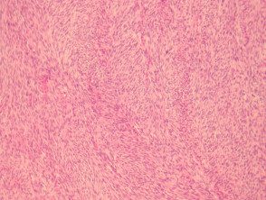 fibrosarcoma-figure-3__protectwyjqcm90zwn0il0_focusfillwzi5ncwymjisingildfd-1399243-8675624