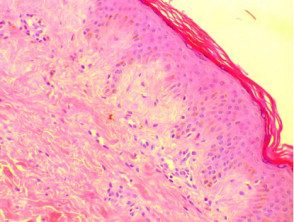 Histología de la amiloidosis cutis dyschromica. H + E