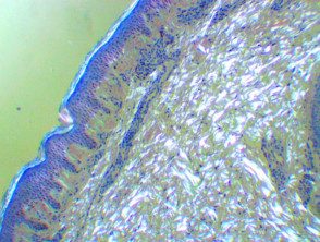 Histología de la amiloidosis cutis dyschromica. Congo polarizado rojo