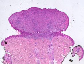 Vista de baja potencia de histología BAP-oma de lesión pedunculada