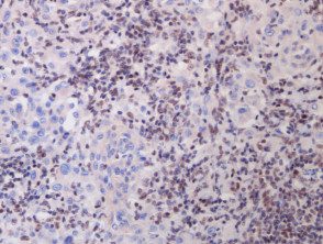 BAP-oma histología x20, IHC. Pérdida de la expresión de BAP1 (tinción marrón) de melanocitos epitelioides más grandes, mientras que los melanocitos regulares retienen la expresión de BAP1.