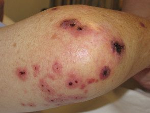 figure-14-feverrash2__protectwyjqcm90zwn0il0_focusfillwzi5ncwymjisingildfd-1144470-4782897