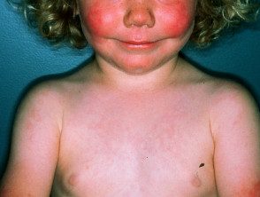 figure-17-feverrash__protectwyjqcm90zwn0il0_focusfillwzi5ncwymjisinkildg1xq-3778841-3038915