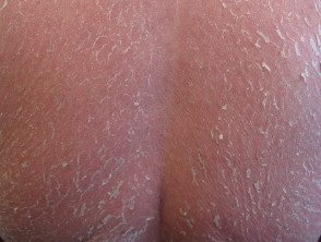 figure-19-feverrash__protectwyjqcm90zwn0il0_focusfillwzi5ncwymjisinkildg1xq-4686638-2806675