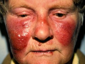 figure-2-feverrash__protectwyjqcm90zwn0il0_focusfillwzi5ncwymjisingildfd-2971758-3590047