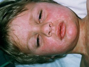 figure-21-feverrash__protectwyjqcm90zwn0il0_focusfillwzi5ncwymjisingildizxq-5246426-8572945