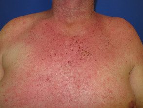 figure-22-feverrash2__protectwyjqcm90zwn0il0_focusfillwzi5ncwymjisingildfd-4390512-9650248