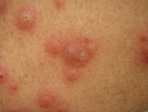 figure-24-feverrash2__protectwyjqcm90zwn0il0_focusfillwzi5ncwymjisingildfd-6758020-9030994