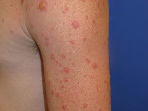 figure-26-feverrash2__protectwyjqcm90zwn0il0_focusfillwzi5ncwymjisinkildg1xq-6548239-5133811