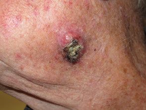 Carcinoma de células escamosas