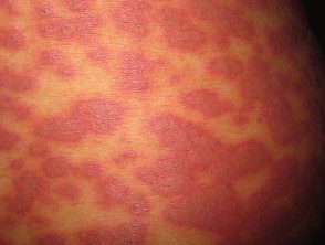 figure-27-feverrash__protectwyjqcm90zwn0il0_focusfillwzi5ncwymjisingildfd-1997380-1928500