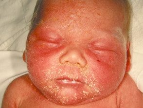 figure-28-feverrash2__protectwyjqcm90zwn0il0_focusfillwzi5ncwymjisingildbd-9417908-5265889