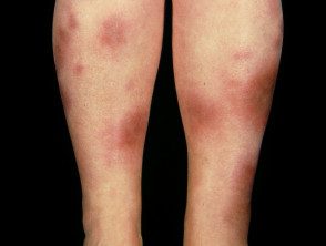 figure-3-feverrash2__protectwyjqcm90zwn0il0_focusfillwzi5ncwymjisinkildg1xq-8384235-2068396