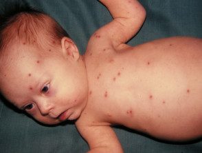 figure-30-feverrash__protectwyjqcm90zwn0il0_focusfillwzi5ncwymjisingildfd-7337417-8663526