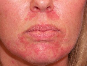 Dermatitis perioral / periorificial