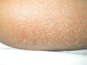 figure-32-feverrash2__protectwyjqcm90zwn0il0_focusfillwzi5ncwymjisingildfd-8198149-6394657