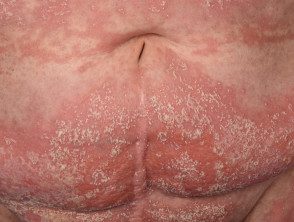 figure-33-feverrash2__protectwyjqcm90zwn0il0_focusfillwzi5ncwymjisingilde5xq-8606453-6787089