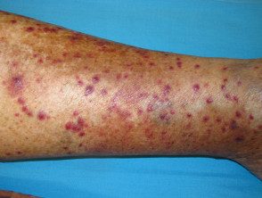 figure-35-feverrash__protectwyjqcm90zwn0il0_focusfillwzi5ncwymjisingildfd-8440668-6556386