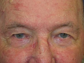 Dermatitis seborreica